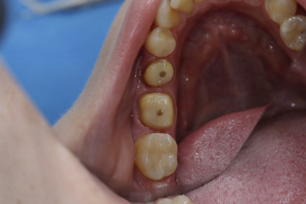 пациент до протезирования