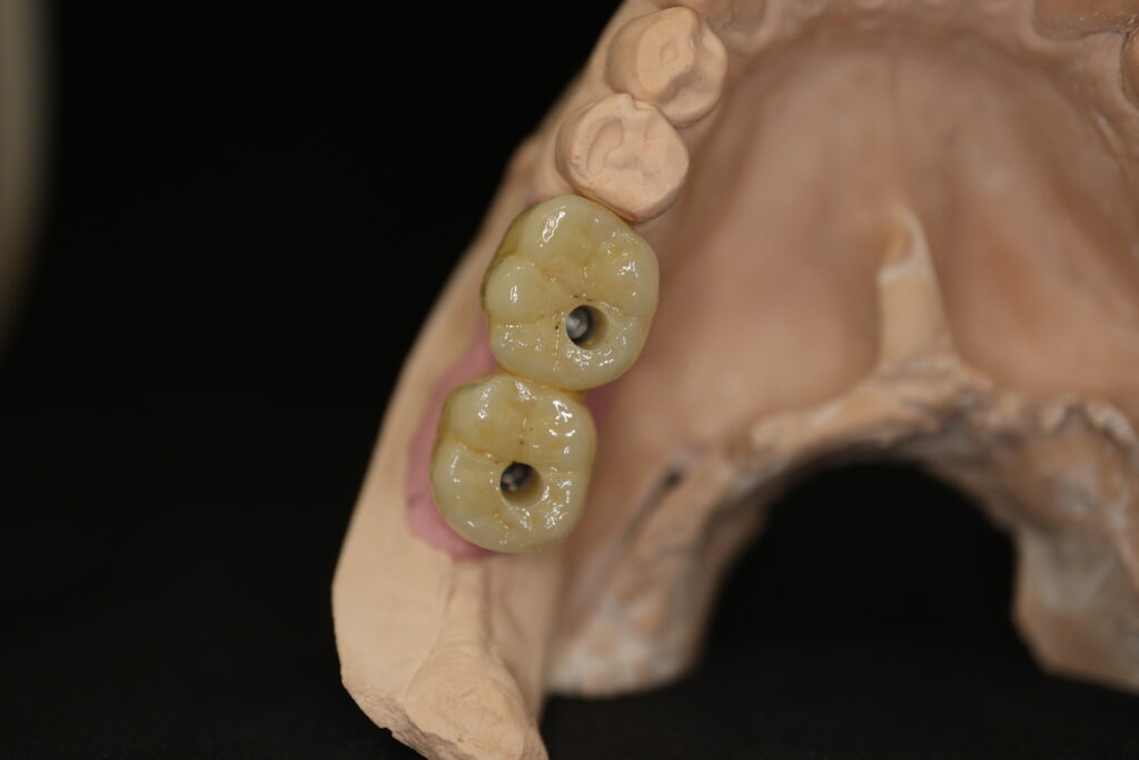 процесс протезирования