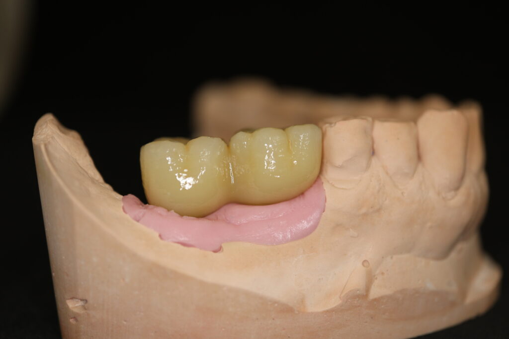 процесс протезирования