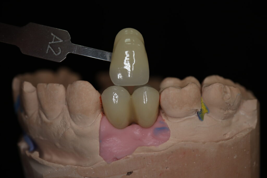 процесс протезирования