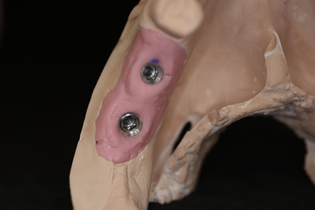 процесс протезирования