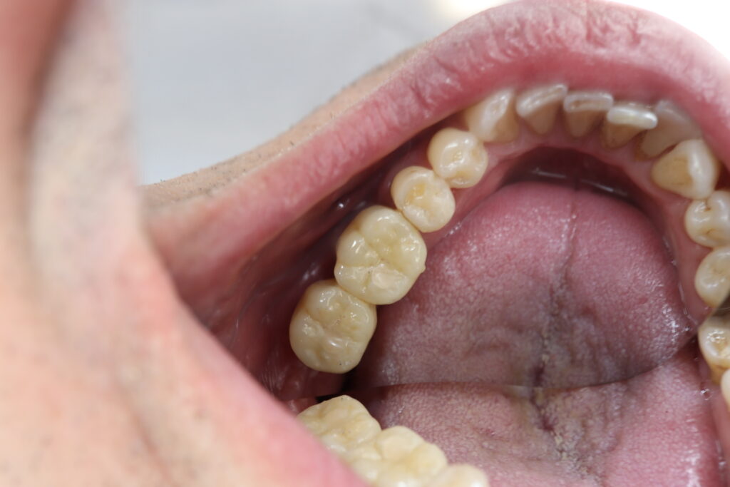 Мост из диоксида циркония на винтовой фиксации с опорой на 2 имплантата Mis Seven.