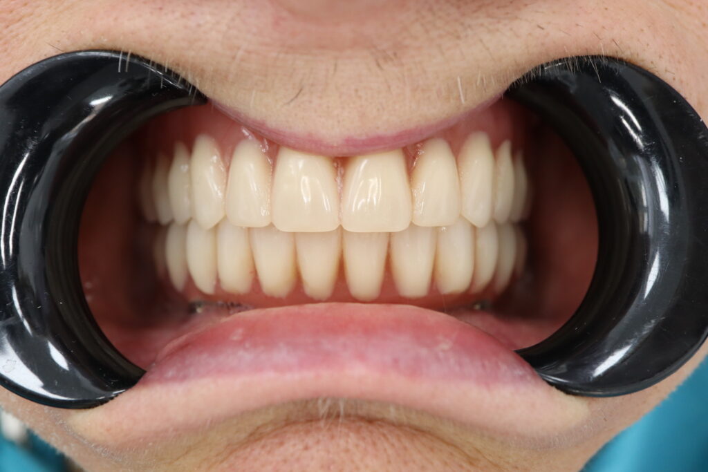 All-on-4 и съёмный протез