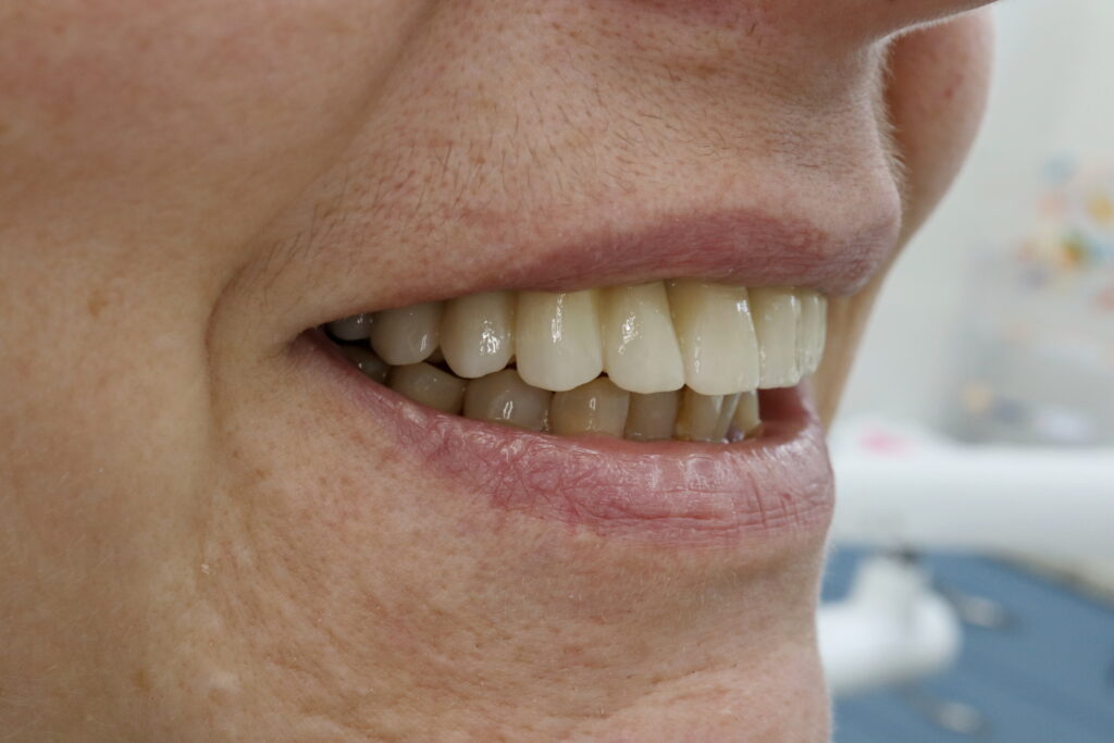 результат имплантации