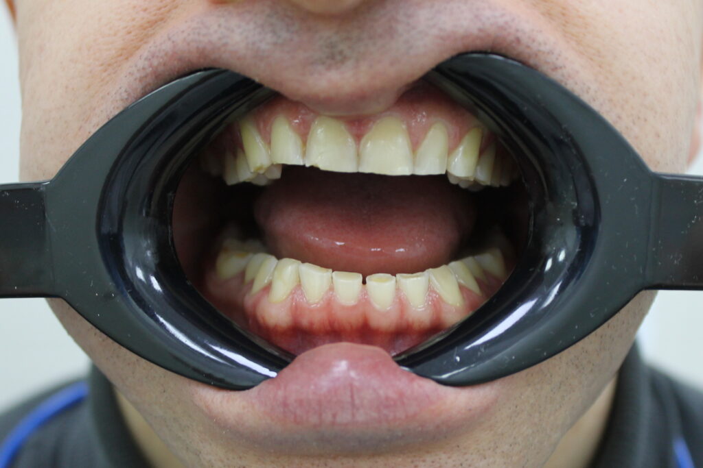 пациент до реставрации