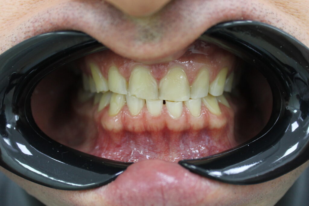 пациент до реставрации