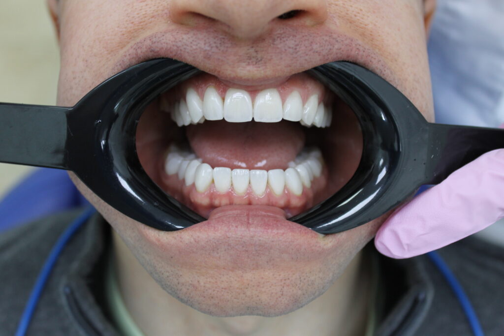 Результат реставрации зубов