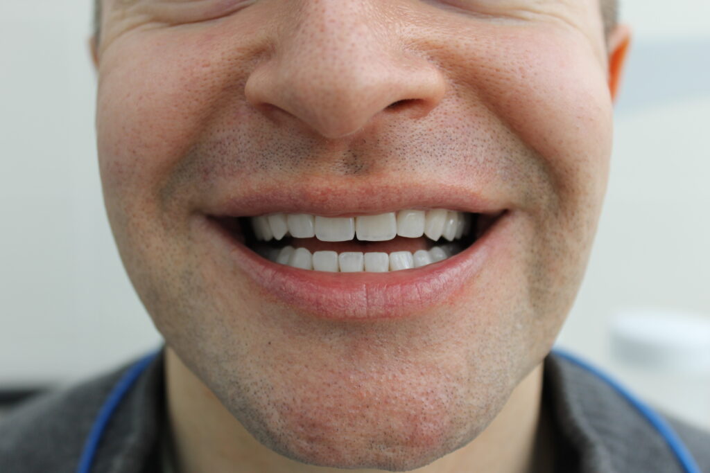 Результат реставрации зубов