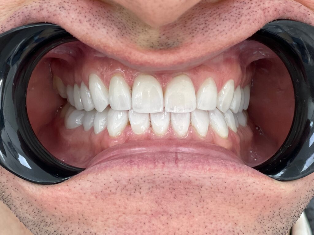 Результат реставрации зубов