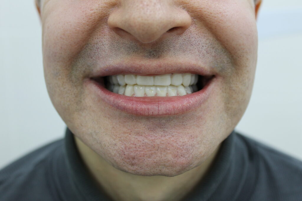 Временные виниры и коронки