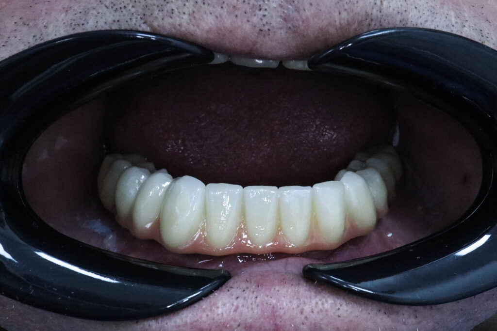 результат протезирования