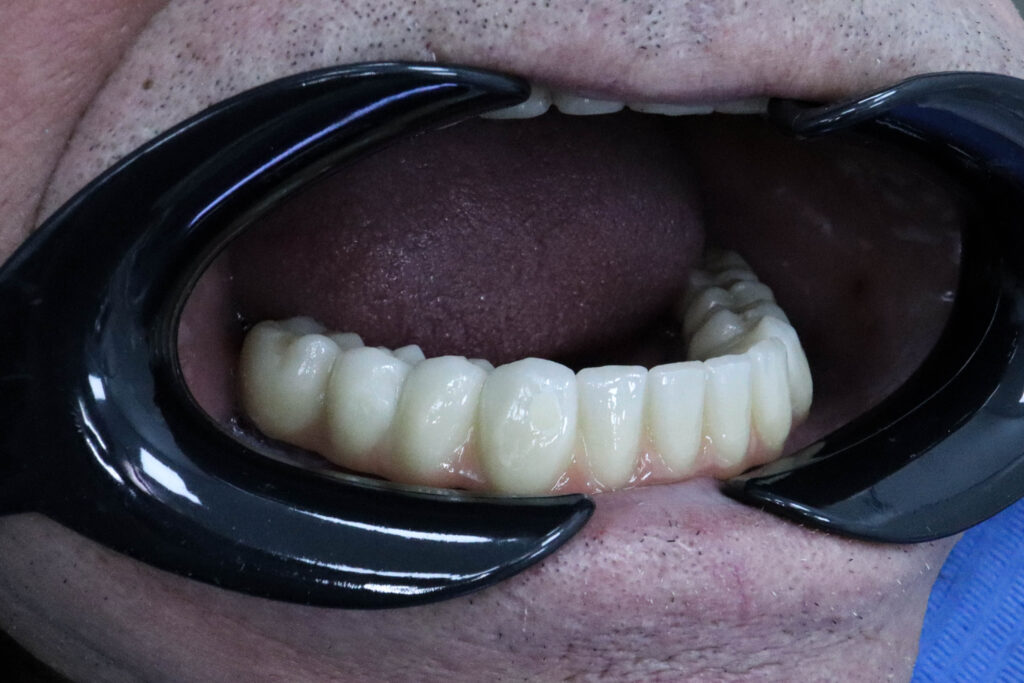 результат протезирования