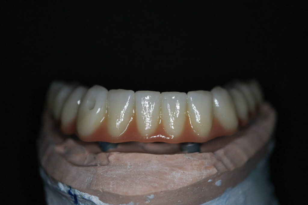 протезы перед установкой