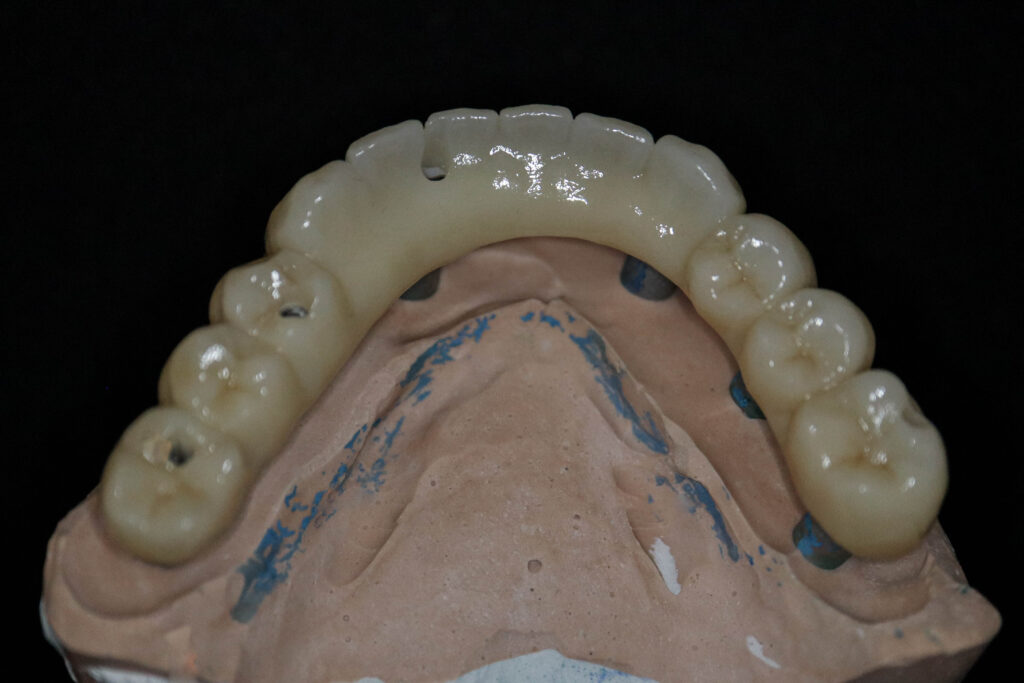 протезы перед установкой