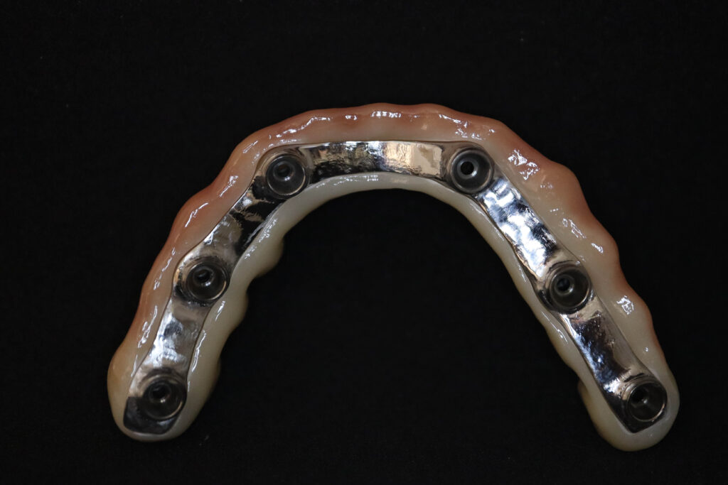 протезы перед установкой