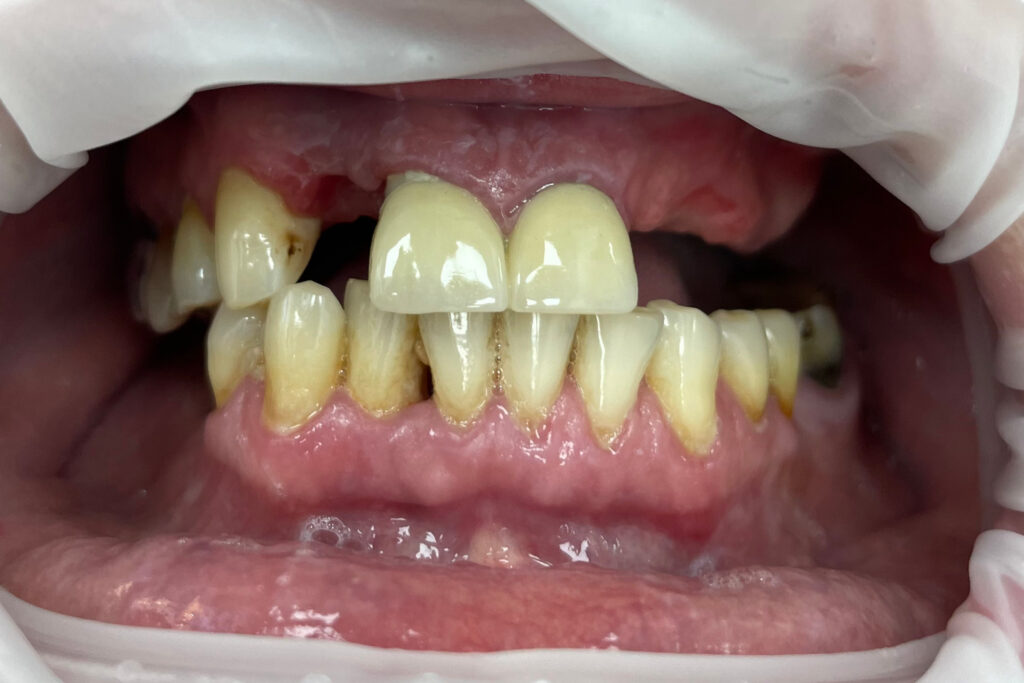 пациент до протезирования