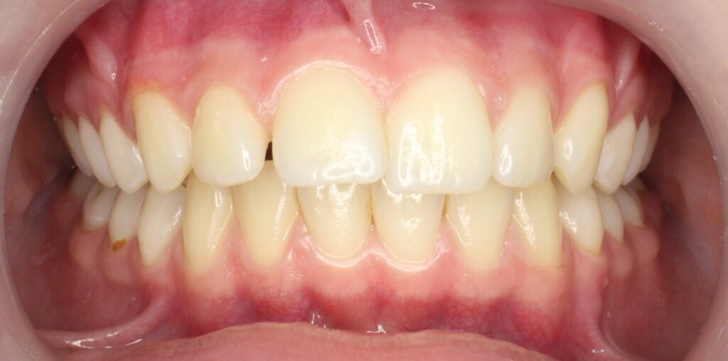 Ситуация до лечения брекетами