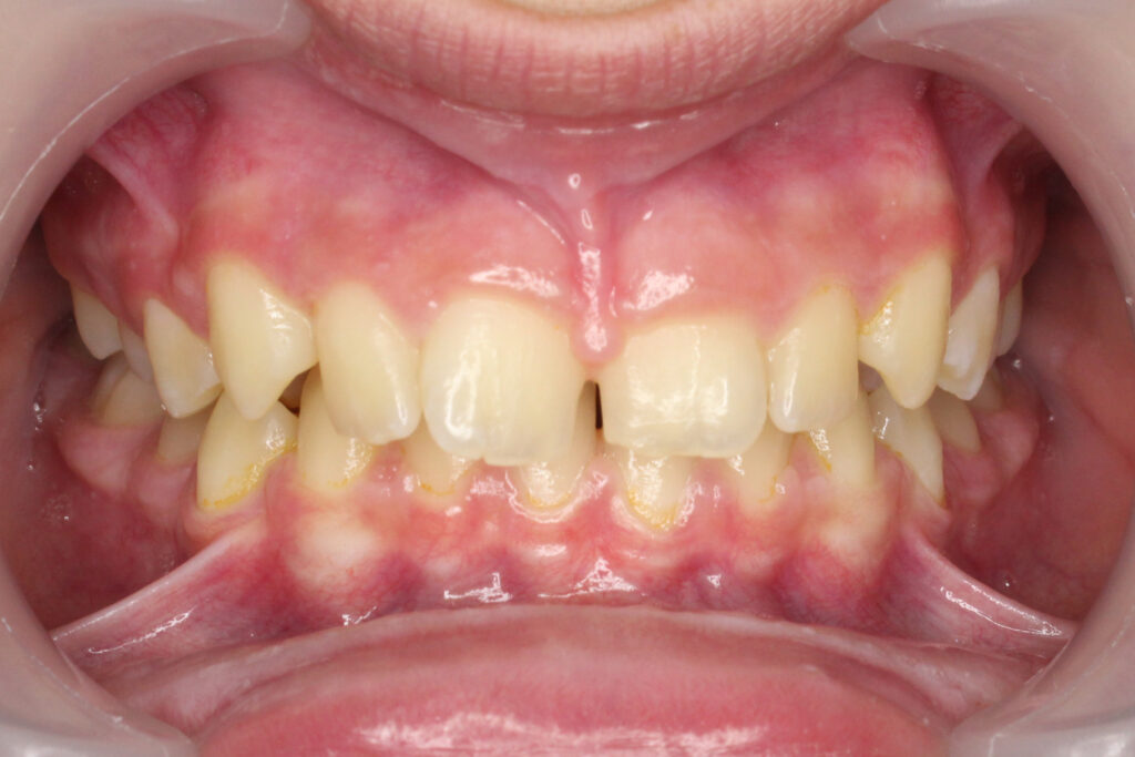 лечение брекет-системой