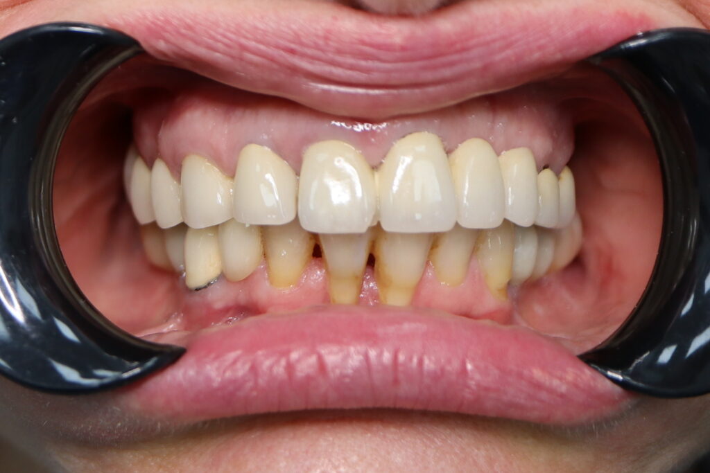 пациент до имплантации