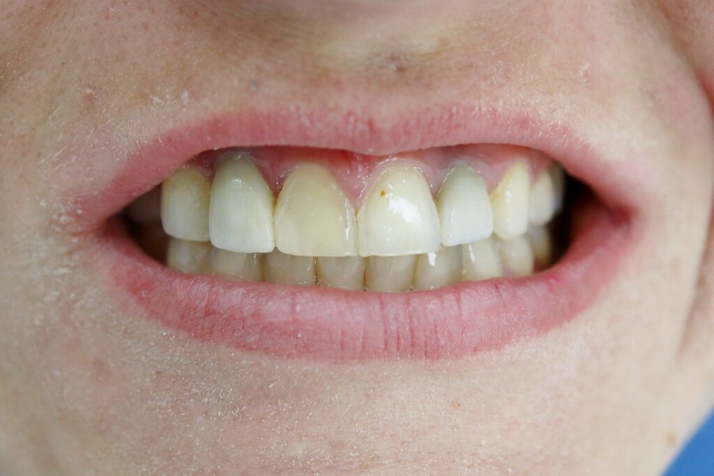 пациент до протезирования