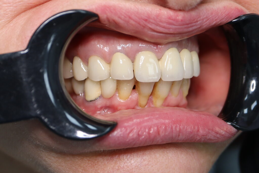 пациент до имплантации