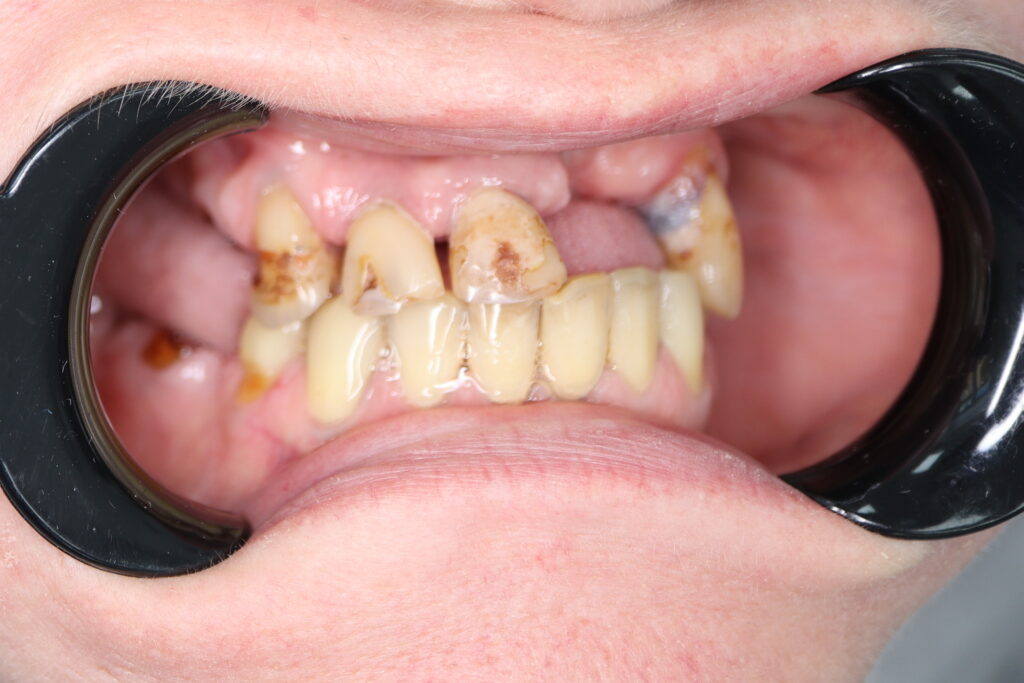 пациент до тотальной имплантации