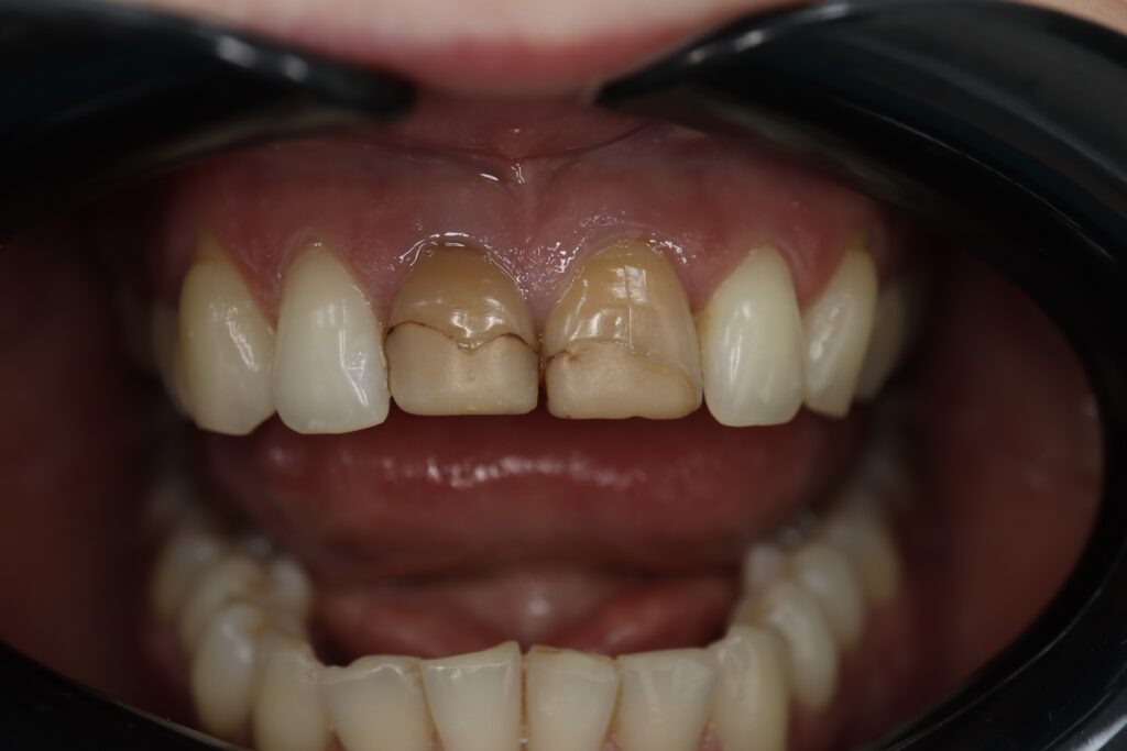 пациент до протезирования