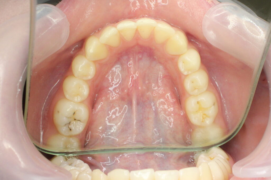 Ситуация до лечения брекетами