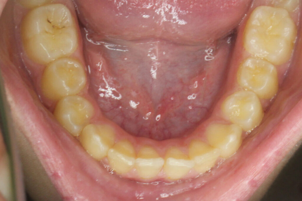 лечение брекет-системой