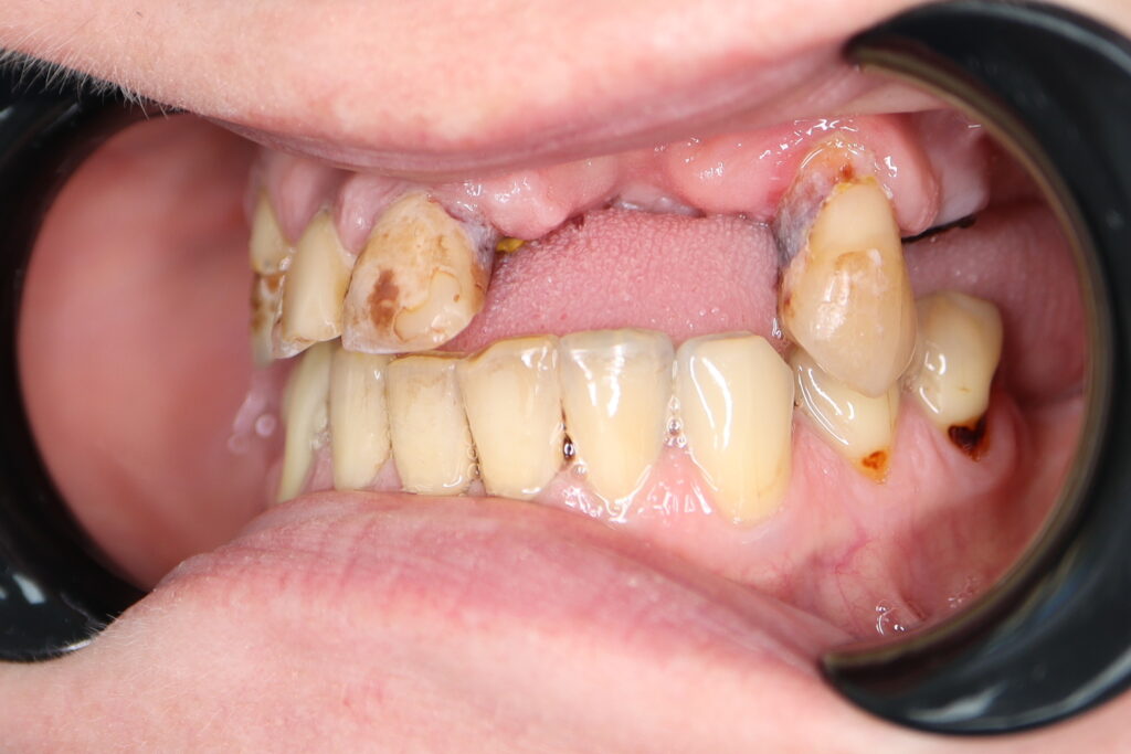 пациент до тотальной имплантации