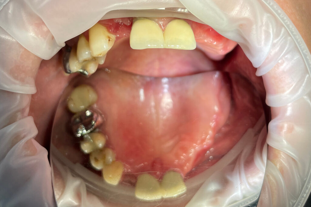пациент до протезирования