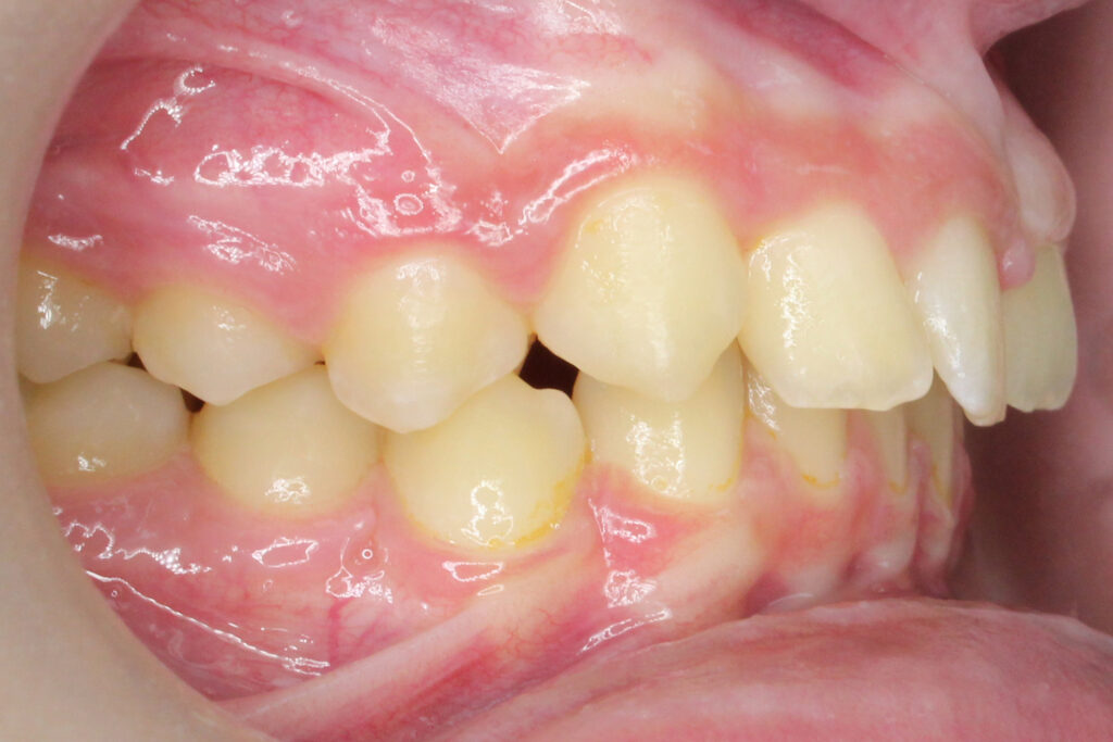 лечение брекет-системой