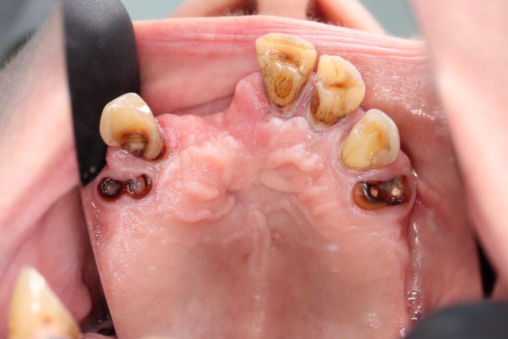 пациент до тотальной имплантации