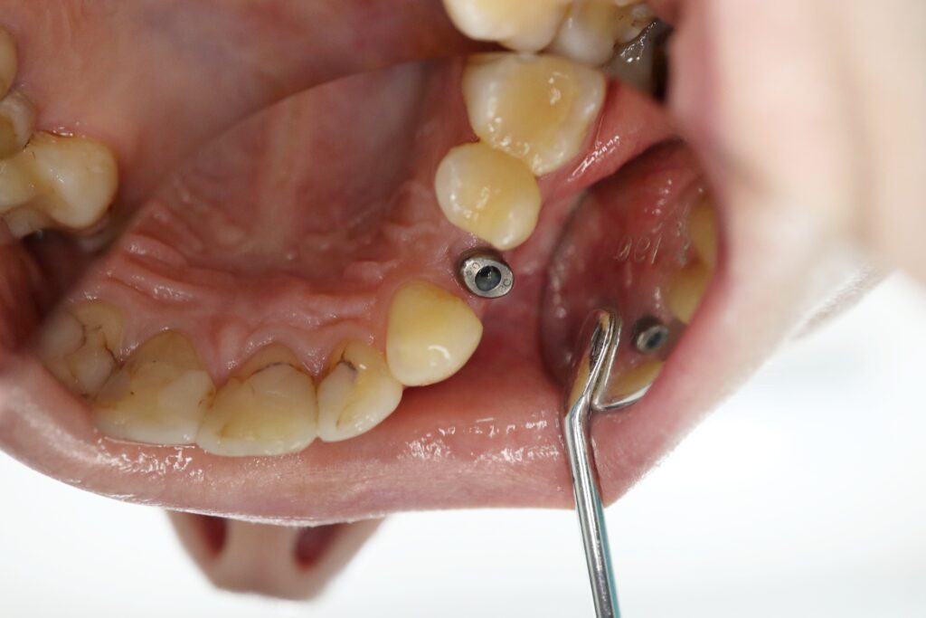 пациент до протезирования