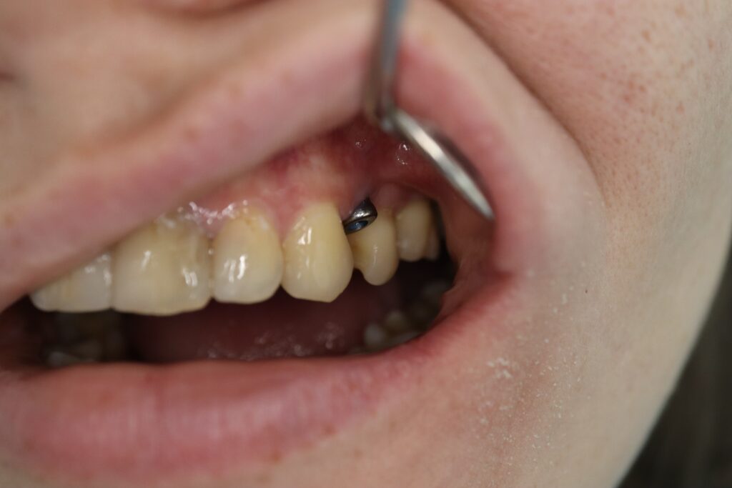 пациент до протезирования