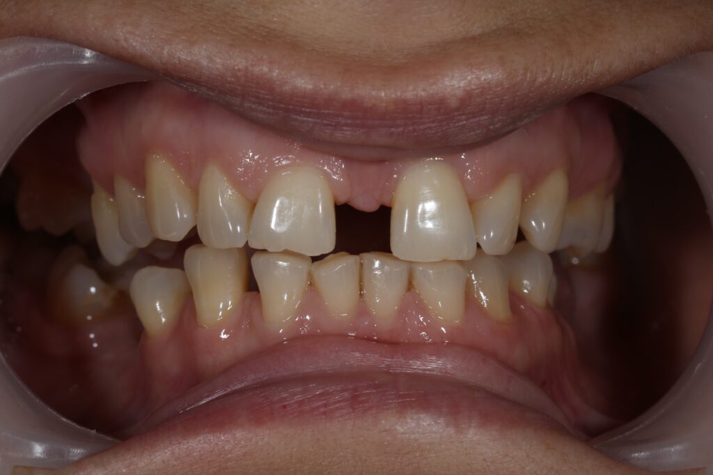 пациент до брекетов