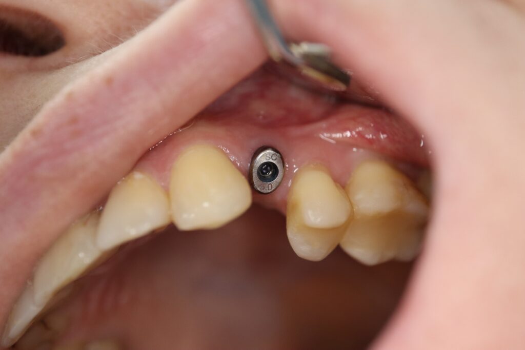 пациент до протезирования