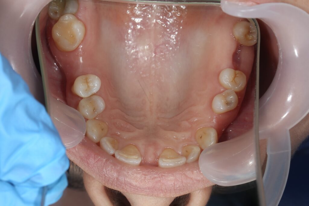 пациент до брекетов