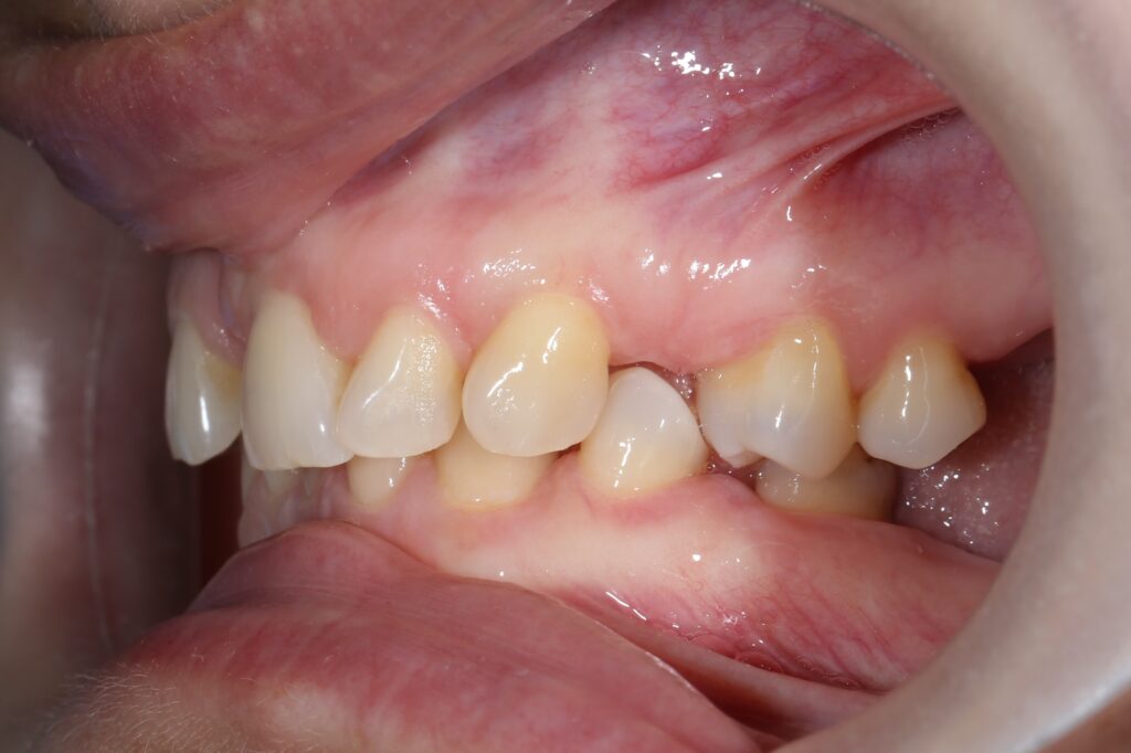 пациент до брекетов