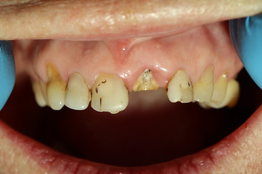 пациент до имплантации