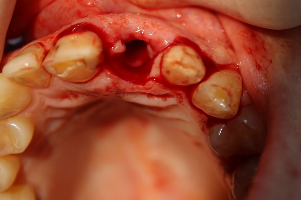 одномоментная имплантация