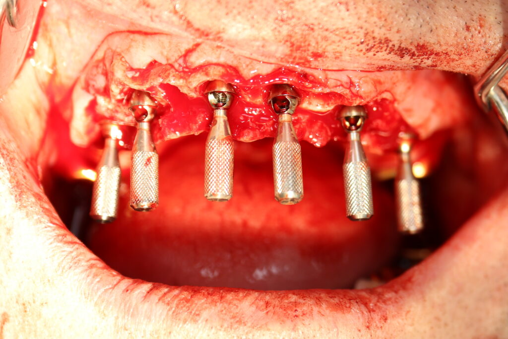 процесс имплантации