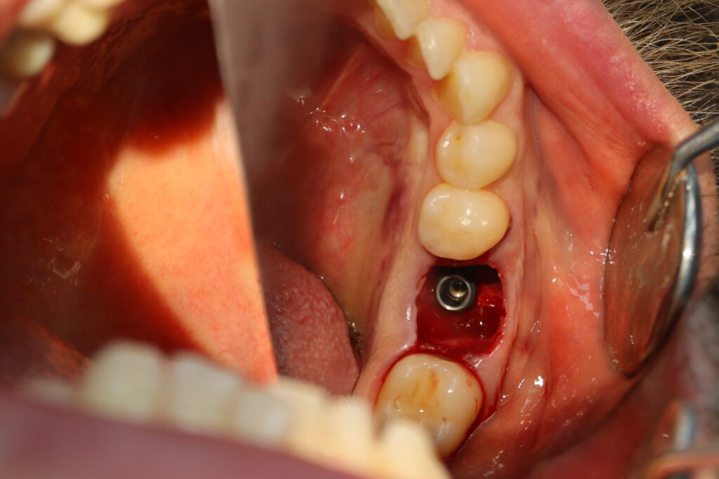 процедура имплантации