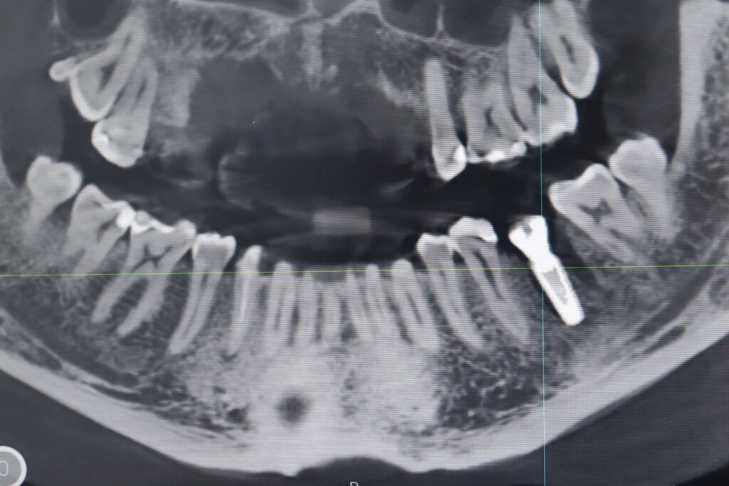 результат одномоментной имплантации