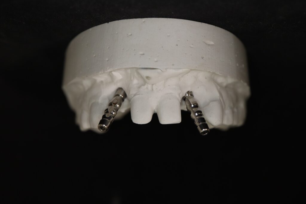 изготовление протеза