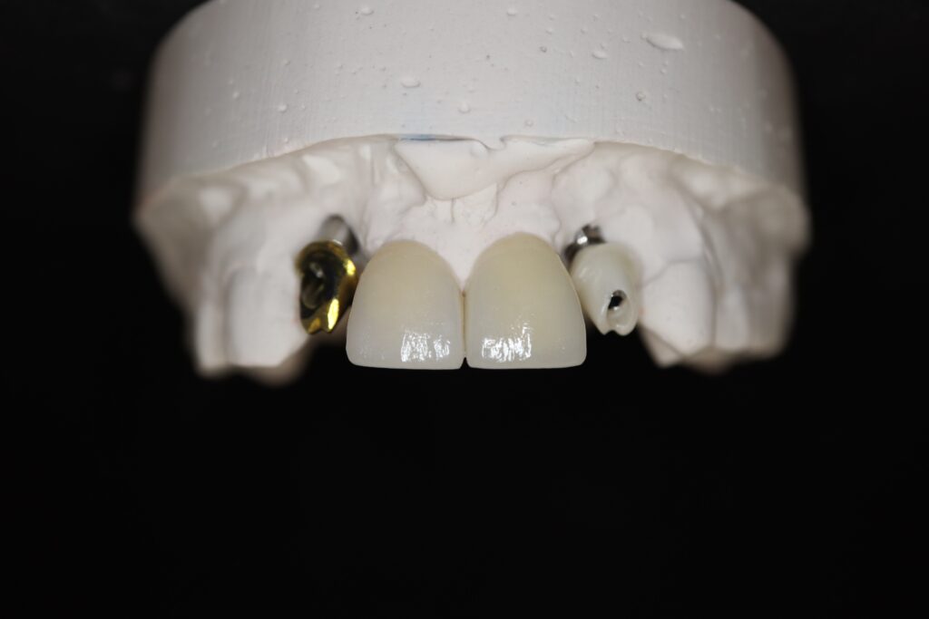изготовление протеза