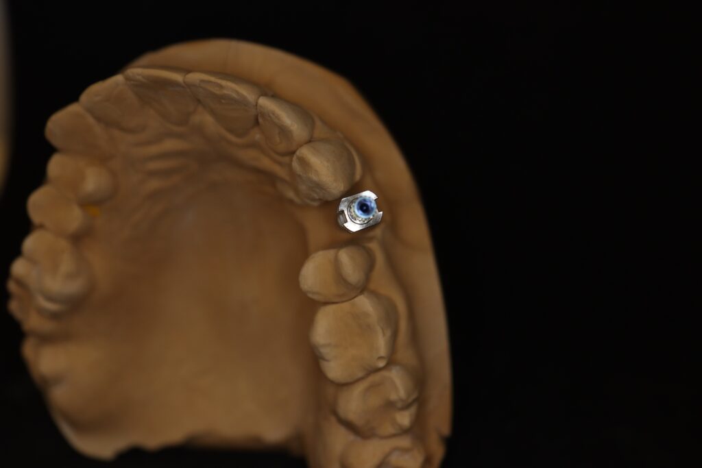 изготовление протеза