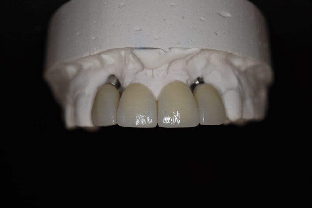 изготовление протеза
