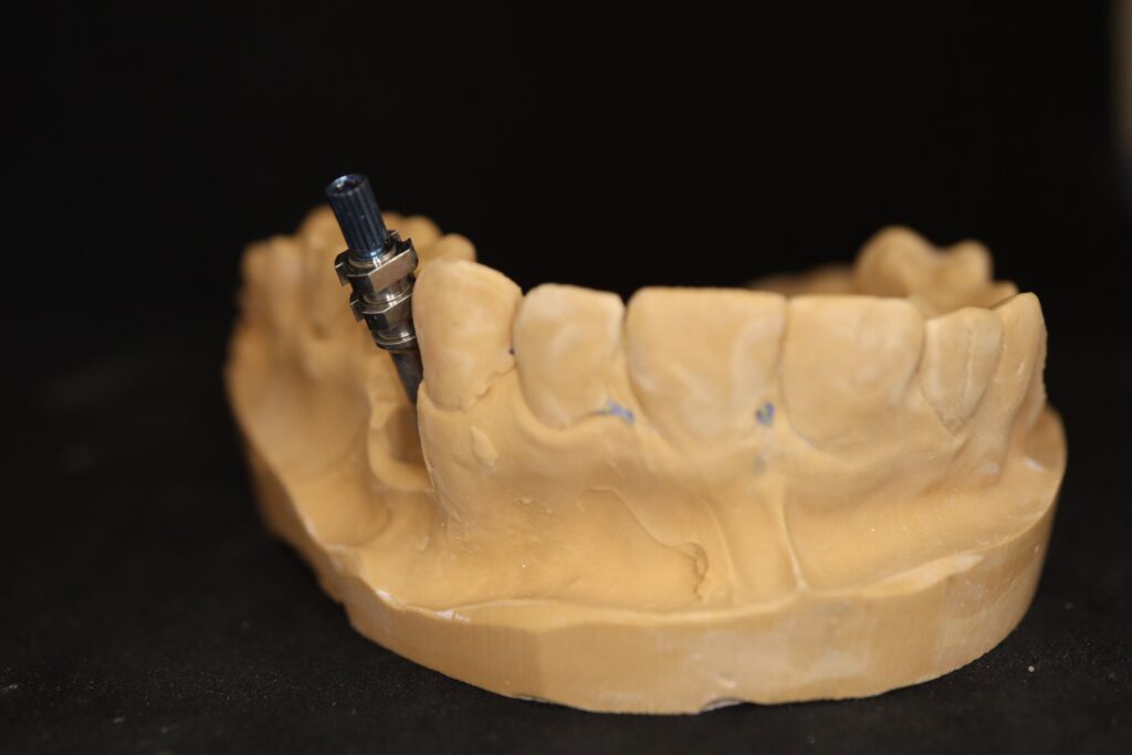 изготовление протеза
