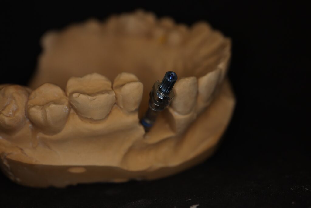 изготовление протеза